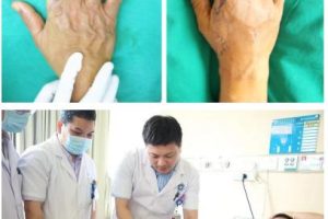 手指缺失10级伤残图九级伤残一共赔几万